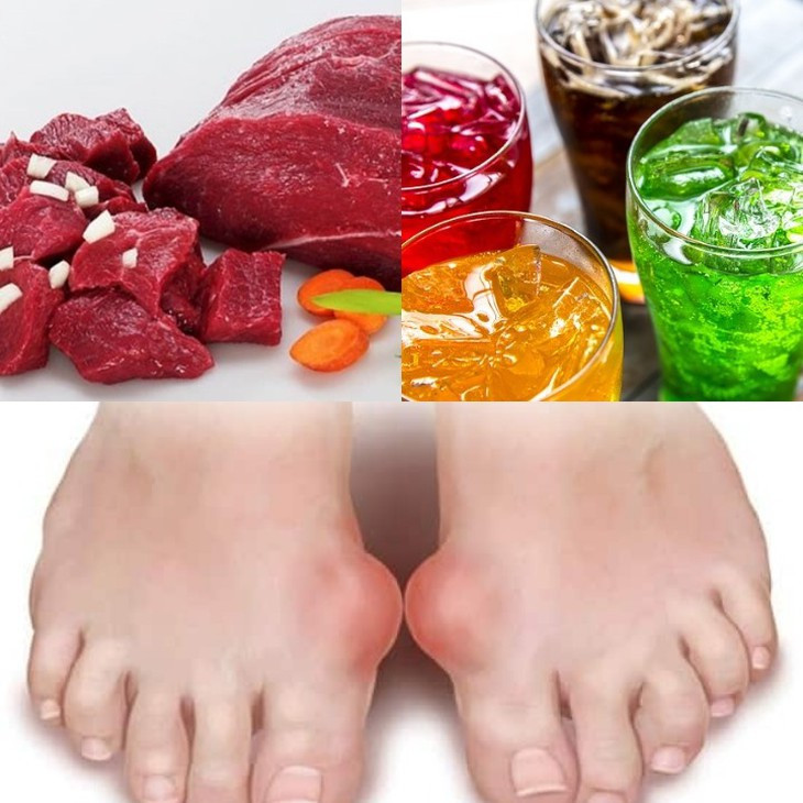 Bị bệnh gout có nên ăn cá?- Ảnh 2.