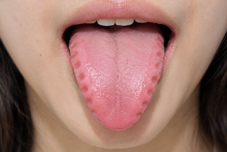 Lưỡi hằn dấu răng cảnh báo điều gì? - Ảnh 1.