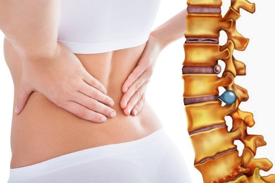 Bị thoát vị đĩa đệm sau khi vác cây