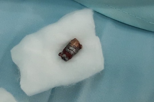 Cấp cứu kịp thời thanh niên bị đạn găm trúng cổ, sốc mất máu