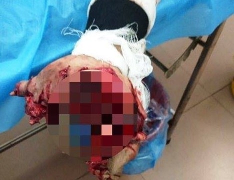 Dùng điện thoại khi đang sạc, nam thanh niên bị nổ tung bàn tay