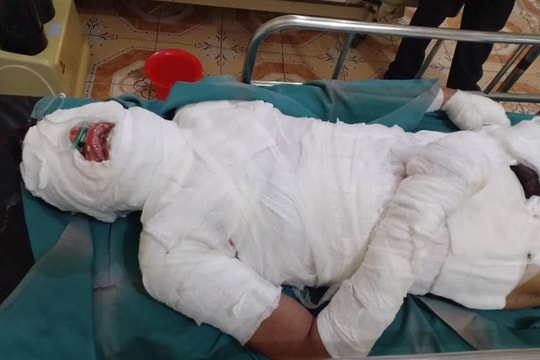 Tình cảnh khốn cùng của người đàn ông dân tộc bị điện cao thế giật bỏng toàn thân ngày cận Tết
