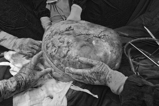 Phẫu thuật lấy thành công khối u nặng 30kg trong cơ thể người