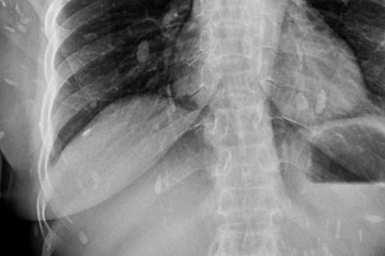 Phát hoảng vì bị sán lá gan sinh sôi khắp cơ thể