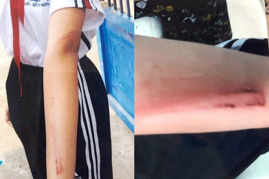 Bé gái mồ côi mẹ bị cha đánh chấn thương phải nhập viện