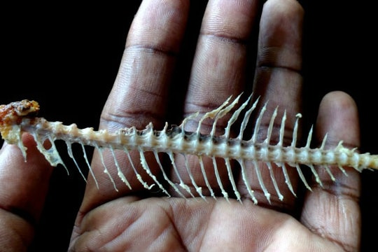 Mổ viêm ruột thừa, bác sĩ phát hiện xương cá đâm xuyên thành ruột