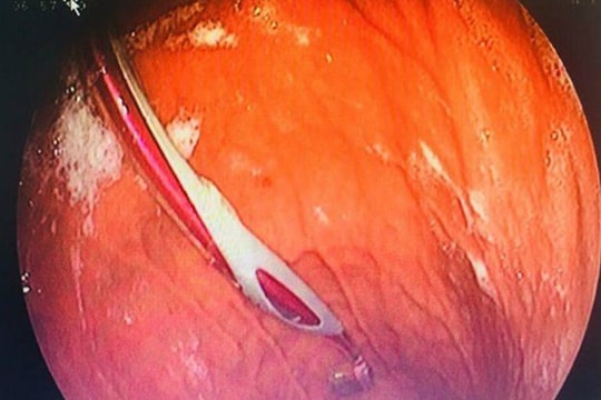 Nuốt trọn bàn chải đánh răng vào dạ dày vì tự xử lý hóc xương cá