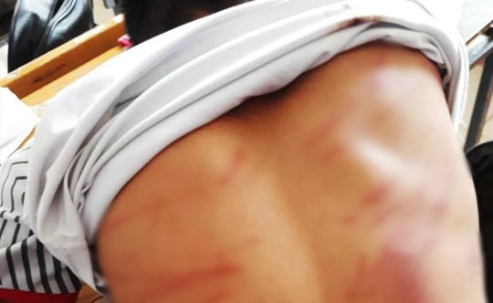 Chơi game điện tử, nam sinh lớp 8 bị bố đánh bầm dập lưng, ngất xỉu tại lớp