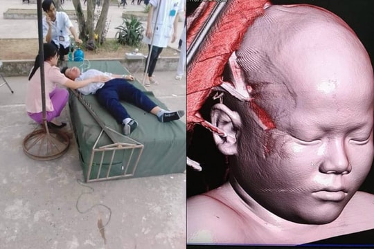Nam sinh lớp 6 nguy kịch vì bị bị cột nhảy cao đổ xuống ghim vào hộp sọ