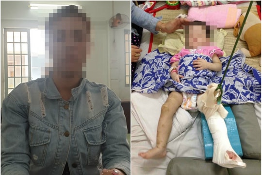 Mẹ nuôi đánh bé gái 1 tuổi gãy chân, đa chấn thương vì biếng ăn, hay khóc