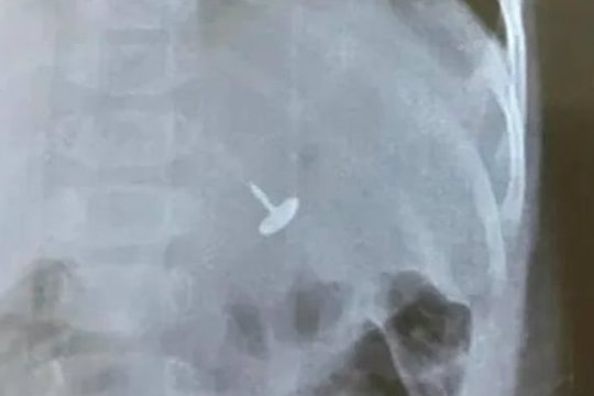 Gắp bỏ chiếc đinh vít sắc nhọn trong dạ dày bé trai 11 tháng tuổi