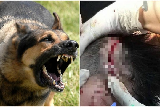 Bé trai 4 tuổi bị chó becgie nhà nuôi tấn công phải nhập viện cấp cứu