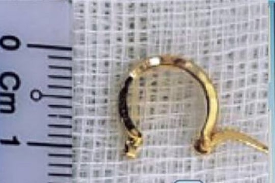 Bé gái 1 tuổi nhập viện cấp cứu vì giật khuyên tai từ bạn và nuốt