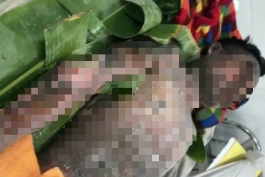 Bếp gas mini bất ngờ phát nổ, nam thanh niên bị bỏng nghiêm trọng