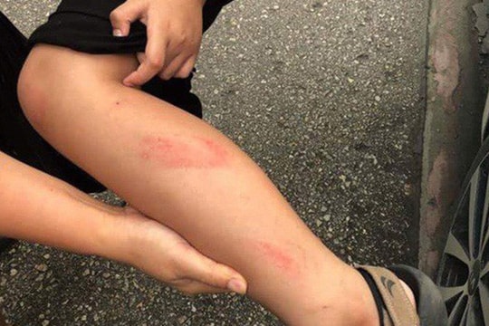 Cô giáo tát học sinh tím thái dương trong giờ kiểm tra học kỳ