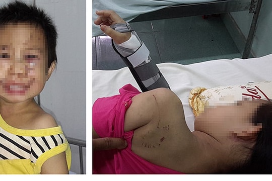 Hai chị em bị chó nhà hàng xóm cắn trọng thương