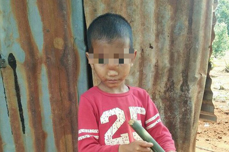 Căn bệnh lạ khiến bé trai 5 tuổi bị tụt não xuống mũi