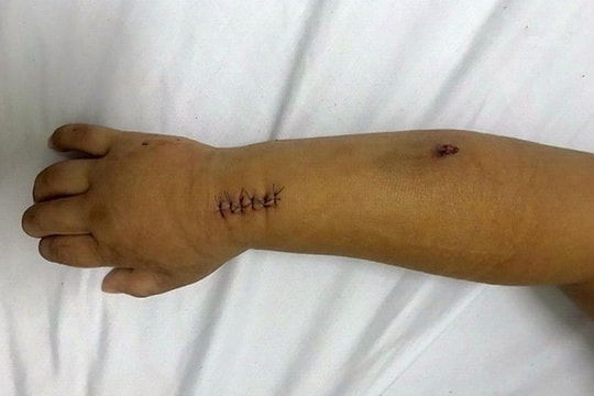 Hà Nội: Bé trai 5 tuổi vô tình bị trúng đạn súng hơi