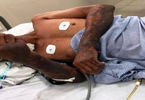 Ăn tiết canh, một người đàn ông bị nhiễm liên cầu lợn tử vong