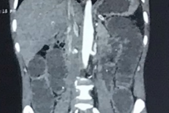 Nuốt xương cá, người đàn ông bị tắc ruột suýt mất mạng