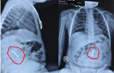Gắp thành công chiếc đinh vít dài 3,5 cm từ tá tràng cháu bé 20 tháng tuổi