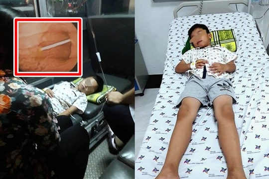 Cấp cứu kịp thời bé trai nuốt thanh nhựa kẹo mút vào họng