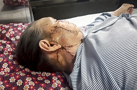 Ghép da thành công cho bệnh nhân cao tuổi bị ung thư da