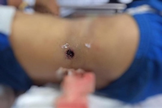 Đeo súng đi săn, người đàn ông bị súng cướp cò bắn thủng bụng nguy kịch