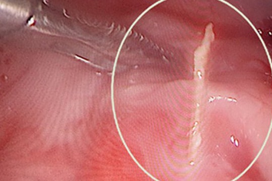 Bé trai bị đâm thủng ruột vì nuốt phải que xiên