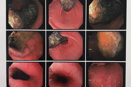 Bé gái 9 tuổi ở Thái Bình mắc chứng nghiện nhổ tóc để... ăn