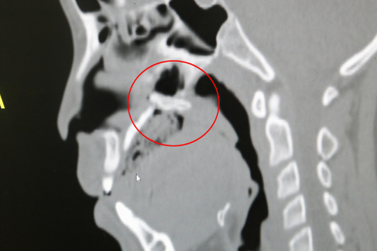 Bé trai 10 tuổi thủng vòm họng do ngã xe đạp