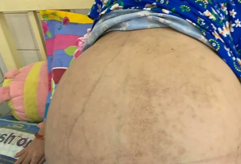 Bé gái 10 tuổi mang khối bướu khổng lồ nặng gần 50kg