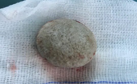 Phẫu thuật lấy viên sỏi hơn 3cm trong bàng quang bé trai 13 tuổi