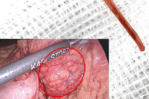 Nữ bệnh nhân bị xương cá đâm thủng ruột