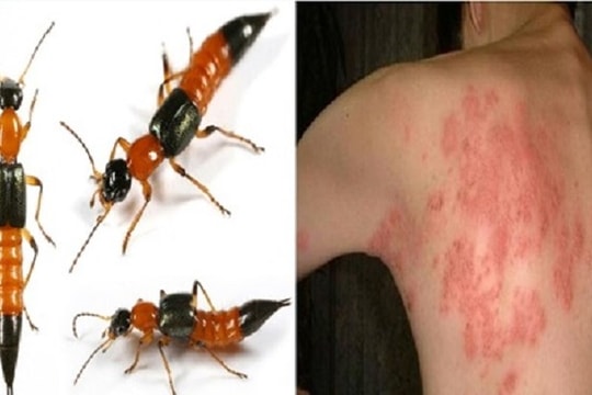 Thanh niên nhập viện cấp cứu vì giã kiến ba khoang đắp lên da để chữa bệnh