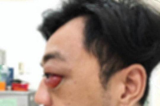 Cứu người đàn ông thoát nguy cơ mù mắt sau 2 năm bị tai nạn giao thông