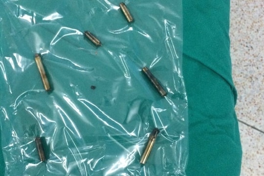 Lấy 8 thanh nam châm trong bụng bé trai 4 tuổi