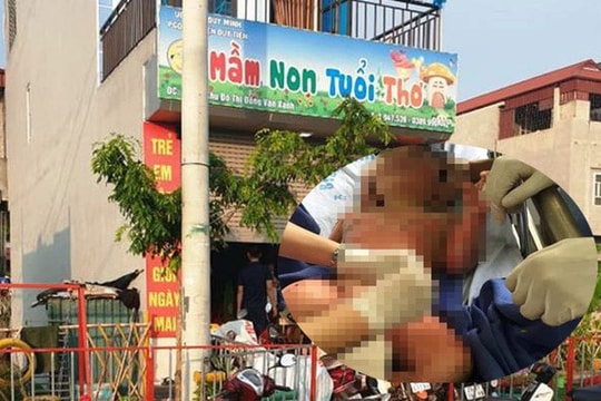 Cô giáo đốt cồn dạy phòng chống cháy nổ, 3 trẻ mầm non bị bỏng nặng