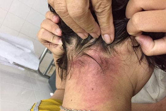 Kiến ba khoang tràn vào bệnh viện tấn công người bệnh