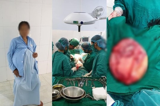 Người phụ nữ mang khối u nang buồng trứng khổng lồ