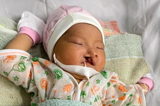 Mẹ bỏ rơi bé sơ sinh bị sứt môi khi vừa chào đời ở bệnh viện