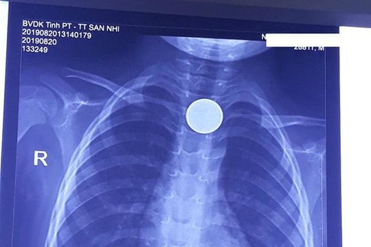 Gắp đồng xu ra khỏi thực quản bé trai 3 tuổi