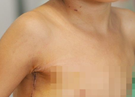 Lần đầu tiên thực hiện phẫu thuật tim bằng kỹ thuật mổ nội soi ít xâm lấn