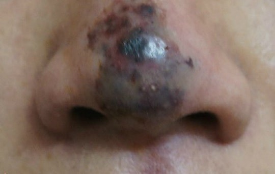 Tiêm filler “rởm” làm đẹp, nam thanh niên nhận cái kết đắng