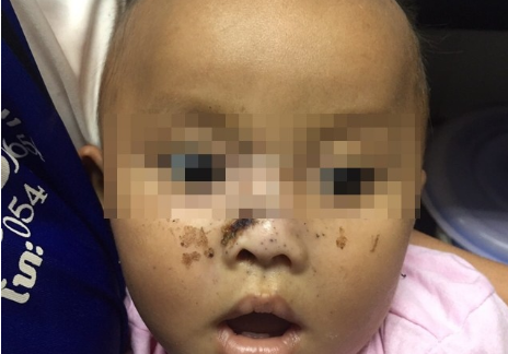 Cứu sống bé trai 9 tháng tuổi bị 2 anh trai bắn súng vào mặt