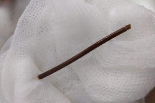 Cụ bà 72 tuổi thủng dạ dày do thói quen ngậm tăm sau khi ăn