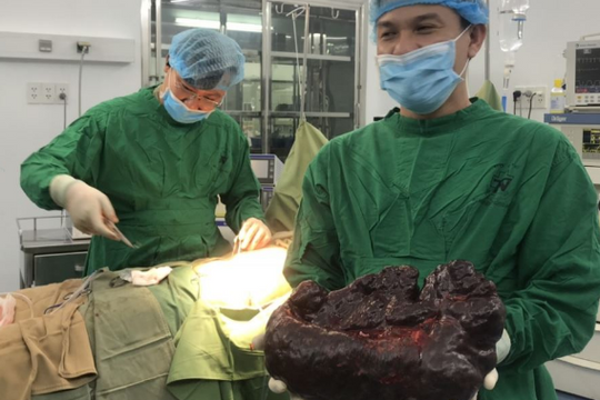 Phẫu thuật cắt bỏ khối u đa nang lách "khổng lồ" cho một phụ nữ