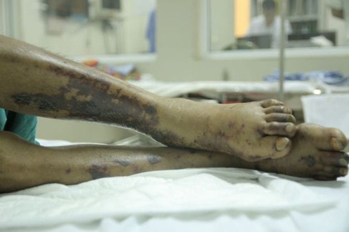 Cụ ông 82 tuổi bị mắc liên cầu lợn vì ăn tiết canh