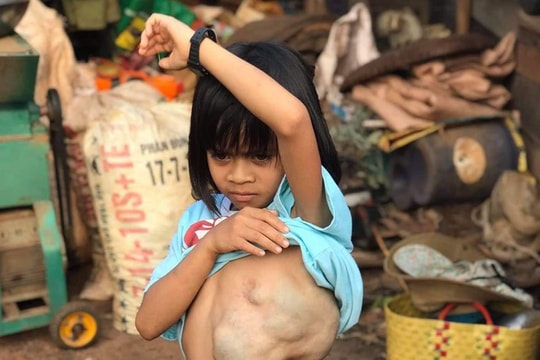 Giải cứu bé gái 8 tuổi mang khối bướu khổng lồ chiếm 1/3 trọng lượng cơ thể