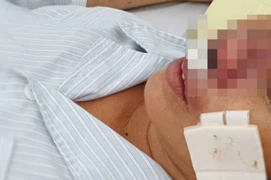 Xuất hiện ca bệnh đầu tiên bị vi khuẩn whitmore ăn cánh mũi